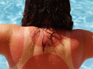 Woman with Sunburnt Back